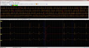 Holter LX PRO Analysis Software by NorthEast Monitoring