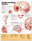 "UNDERSTANDING STROKE" LAMINATED ANATOMICAL CHART