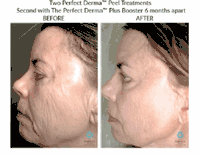 How Many Peels Will I Need for the Best Results?