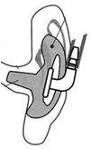 Acoustic Tube Assembly and EarMold Insert Instructions