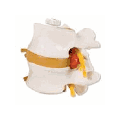 2 Lumbar Vertebrae with Prolapsed Disc