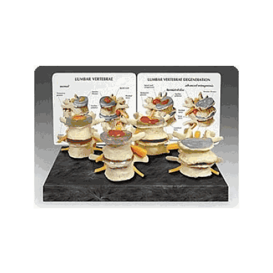 4 Stage Vertebrae Set - Medline