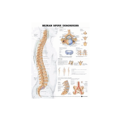 Anatomical Chart, 20" x 26" Human Spine Disorders