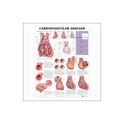 Anatomical Chart Cardiovascular Disease - Cha