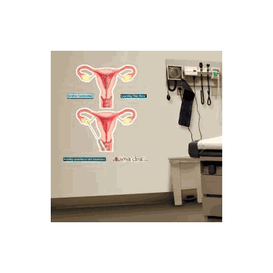 Anatomical Chart In-vitro Fertilization - Cha