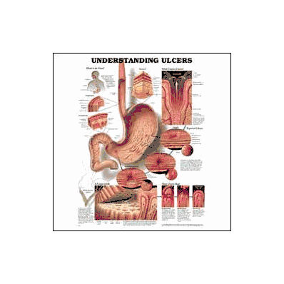 Anatomical Chart Understanding Ulcers - Chart