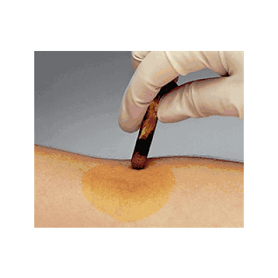 Applicator, Ampule, Benzoin Tincture - Medlin