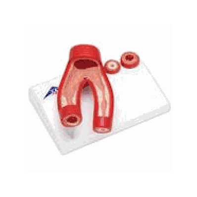 Arteriosclerosis Model, with cross section of artery, 2 part