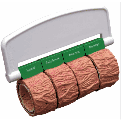 Artery Cross Section demonstrating 4 stages of atherosclerosis