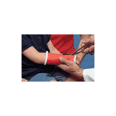 Cast Tape Delta-cast 1 Inch X 6 Foot Polyest