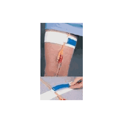 Catheter Holder Hook And Loop Closure, Non Sl