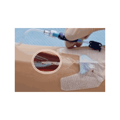 Catheter Nexiva Diffusics 22g X 1.00" - Medli