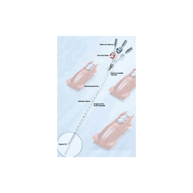 Central Venous Catheter Tray, 12 Fr. X 23 cm Hickman