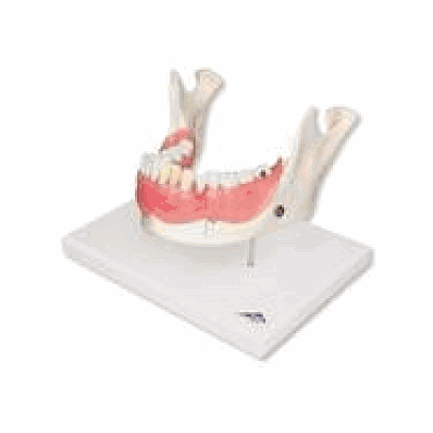 Dental disease, magnified 2 times, 21 parts