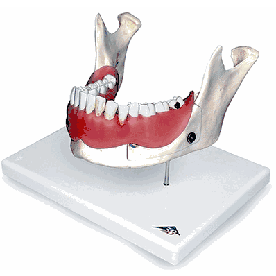 Dental Disease Model