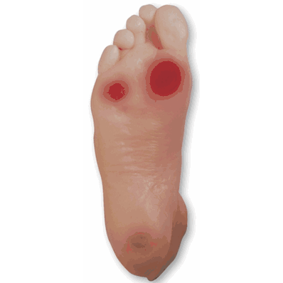Diabetic Foot Model