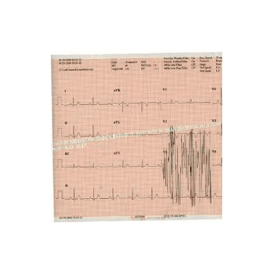 Ecg Recording Chart Paper Thermal 216 X 280 M