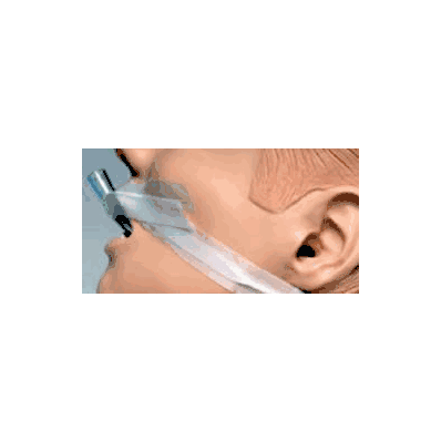 Et Adhesive Securement Device - Tape, Trach E