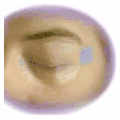 EyeGard, Adult