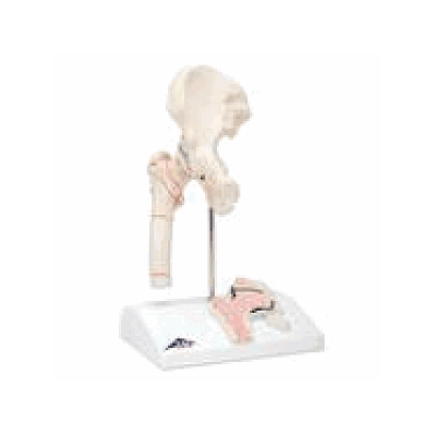 Femoral Fracture and Hip Osteoarthritis