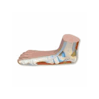 Flat Foot (Pes Panus)