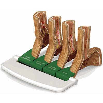 Gerd Reflux Disease Model