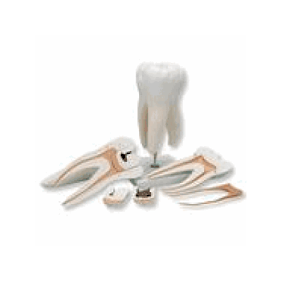 Giant Molar, Dental Cavities, 6 Part