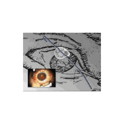 Grieshaber Iris Dilator Retractor