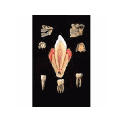 Healthy Denture Chart with wooden rods