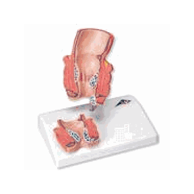 Hemorrhoid Model