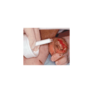 Hydrogel Dressing Intrasite 15 Gm - Gel, Intr