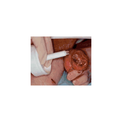Hydrogel Dressing Intrasite 25 Gm - Gel, Intr