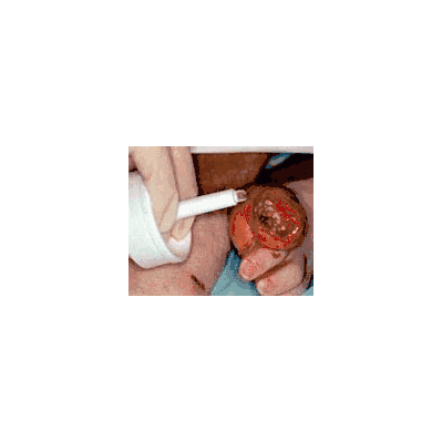 Hydrogel Dressing Intrasite 8 Gm - Gel, Intra
