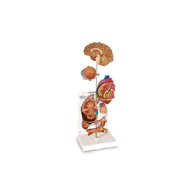 Hypertension Model Set - Model, Hypertension
