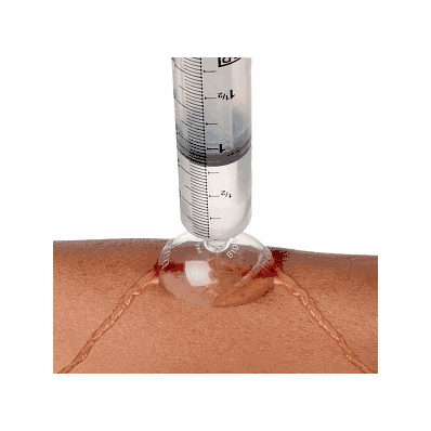 Irrigator, Wound, Igloo - Medline