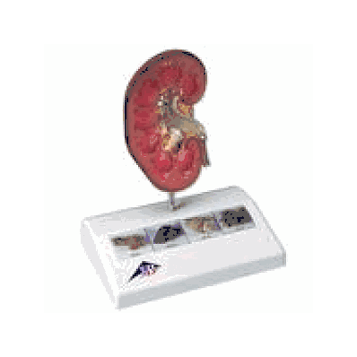 Kidney Stone Model