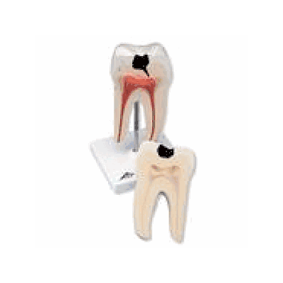 Lower Twin-Root Molar showing cavities, 2 part