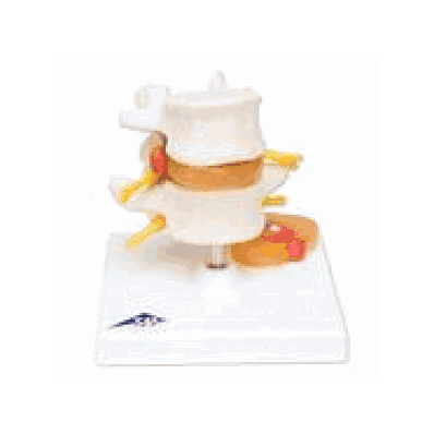 Lumbar Spinal Column with Prolapsed Intervertebral Disc