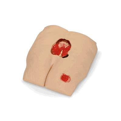 Manikin, Stan, Iv Pressure Ulcer - Medline
