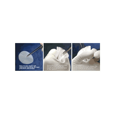 Mesh, Srg Plug Polypropylne, Sm, Non-absorb -