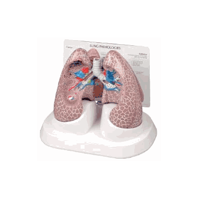 Model, Lung W/Pathologies Cut-away 4 1/4x5 1/