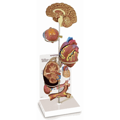 Model Set Hypertension