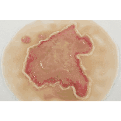 Chemical Burn, Manikin Set4