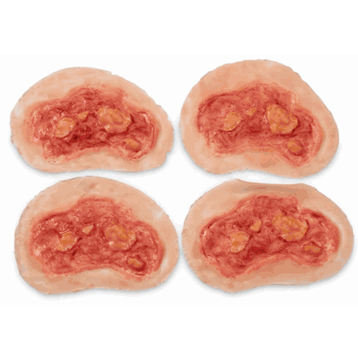 Electrical Burn Mankin Set 4