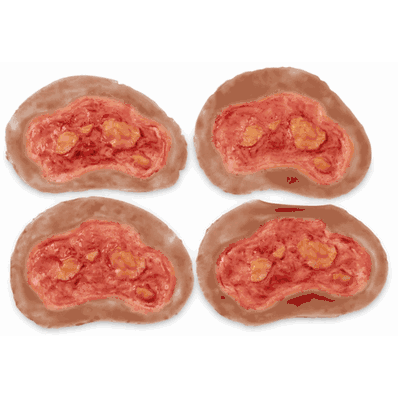 Electrical Burn Medium Set4
