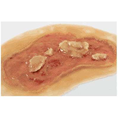 Electrical Burn Medium Single
