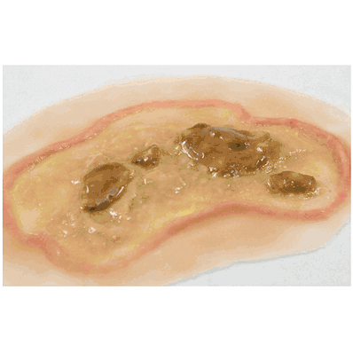Large Ulcer, Manikin Single