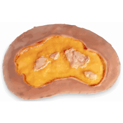 Large Ulcer, Medium Single