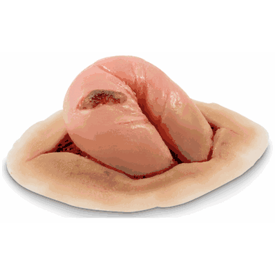 Wound Perforated Bowel Light