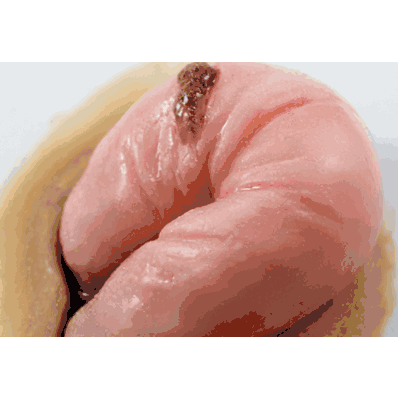 Wound Perforated Bowel Med